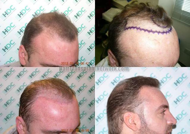 air transplantation surgery before and after pictures