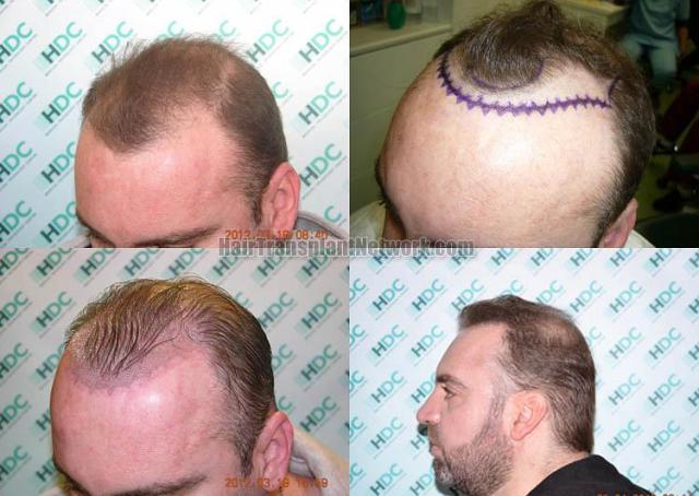 Hair restoration procedure before and after pictures