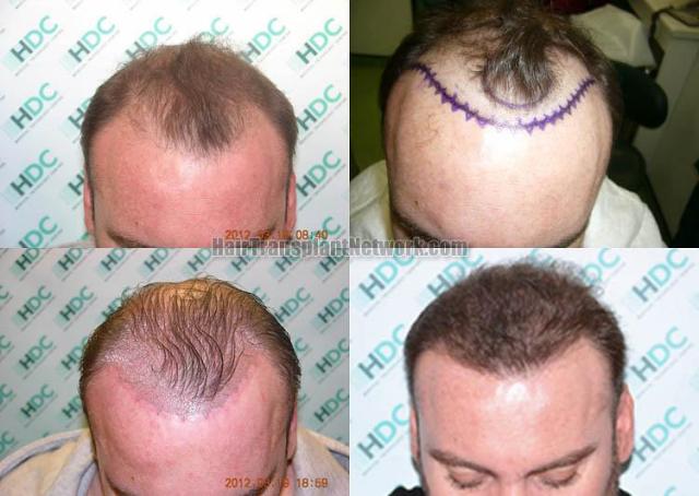 Hair restoration procedure before and after results