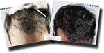 Top view before and after hair restoration results