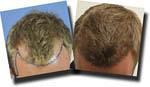 Hair transplantation surgery before and after pictures