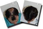 Hair restoration procedure before and after results