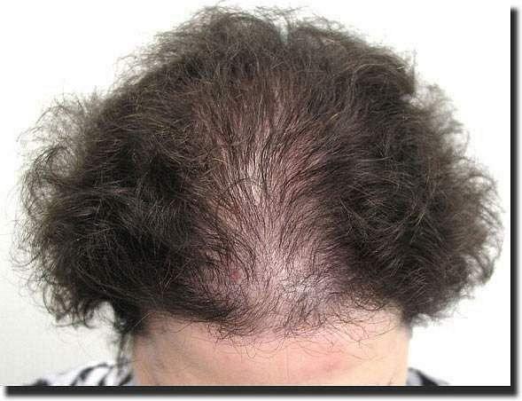 Hair restoration procedure results