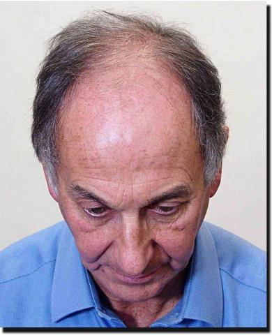 Hair restoration procedure results