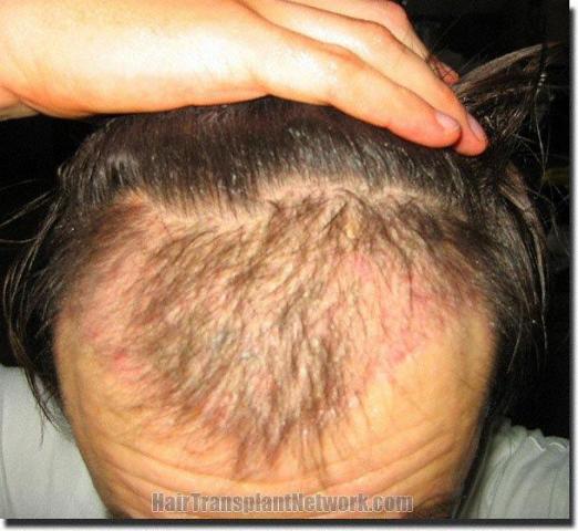 Hair restoration procedure results