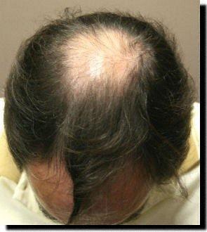 Hair restoration procedure results