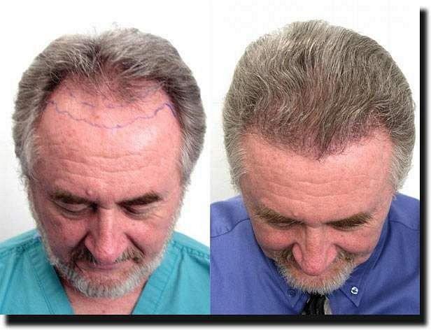 Hair restoration procedure results