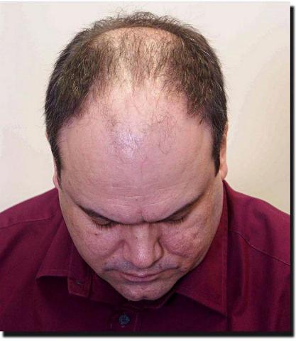 Hair restoration procedure results