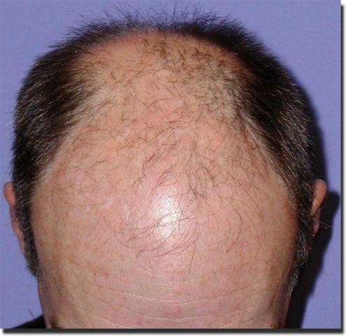 Hair restoration procedure results