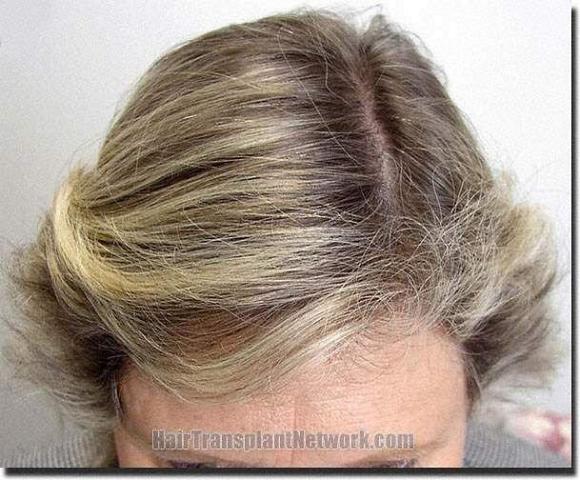 Hair restoration procedure results