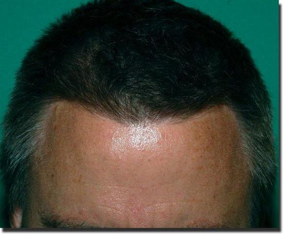 Hair restoration procedure results