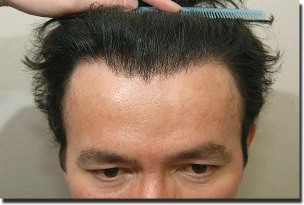 Hair restoration procedure results