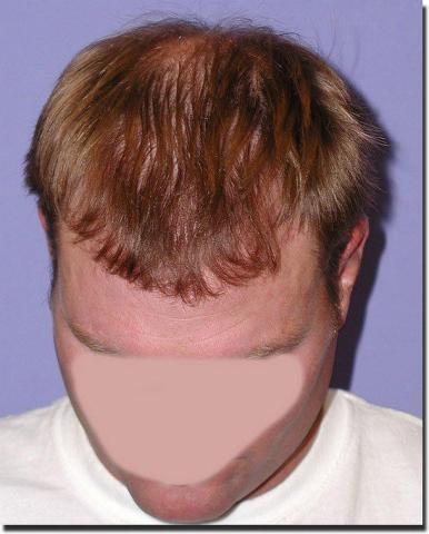 Hair restoration procedure results