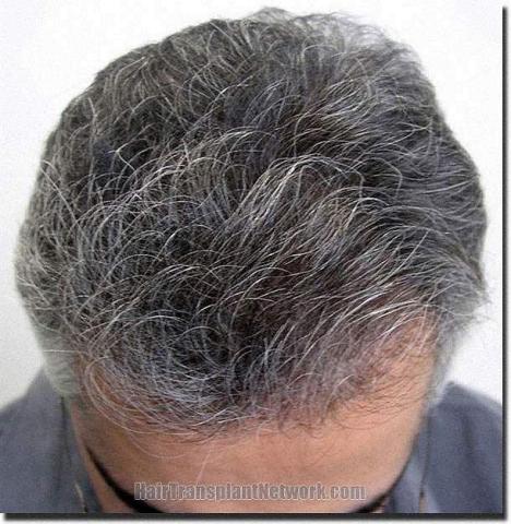 Hair restoration procedure results