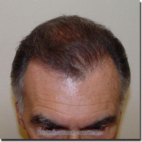 Hair restoration procedure results