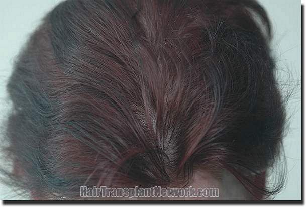 Hair restoration procedure results