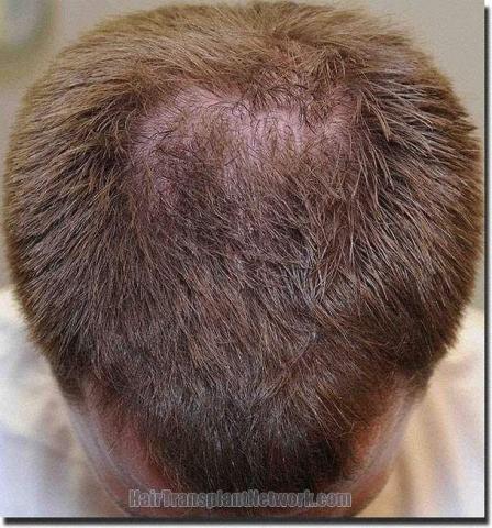 Hair restoration procedure results