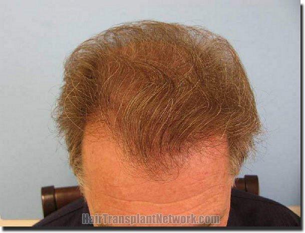 Hair restoration procedure results