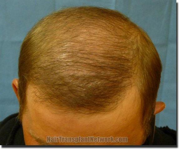 Hair restoration procedure results