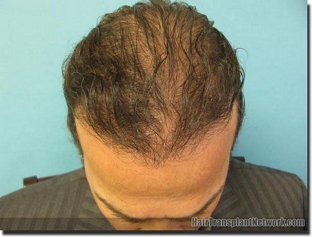 Hair restoration procedure results