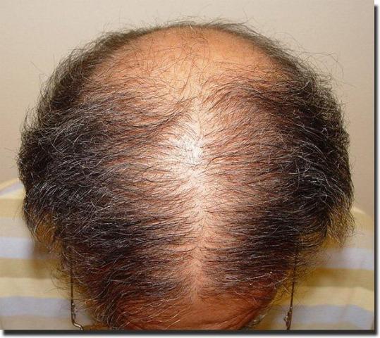 Hair restoration procedure results