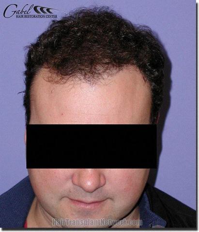 Hair restoration procedure results