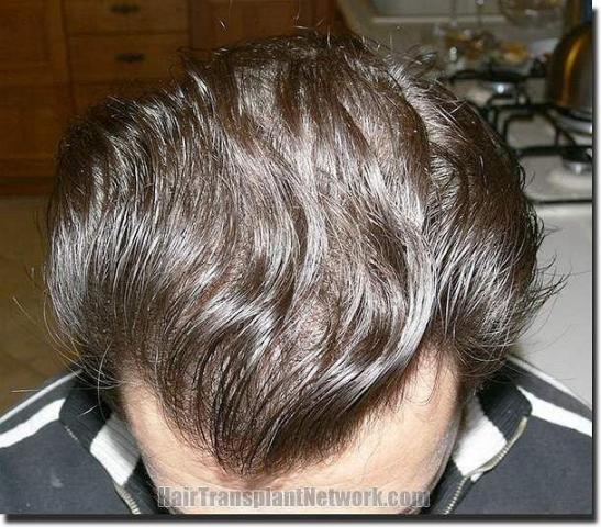 Hair restoration procedure results