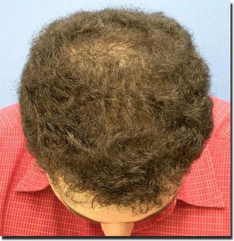 Hair restoration procedure results