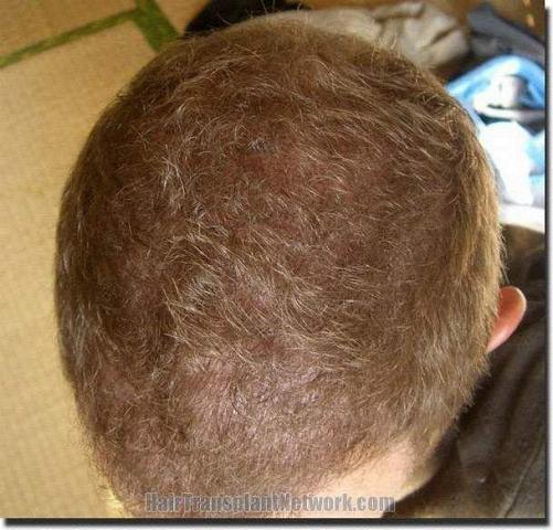 Hair restoration procedure results