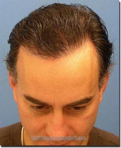 Hair restoration procedure results