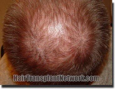 Hair restoration procedure results