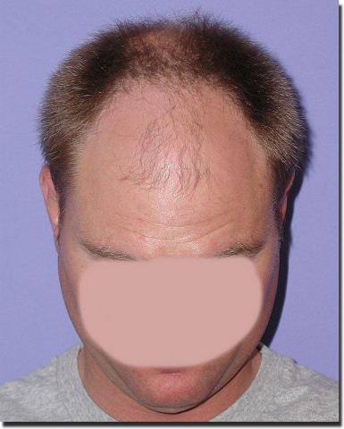 Hair restoration procedure results