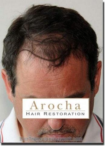 Hair restoration procedure results