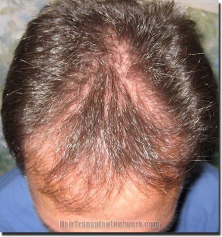 Hair restoration procedure results