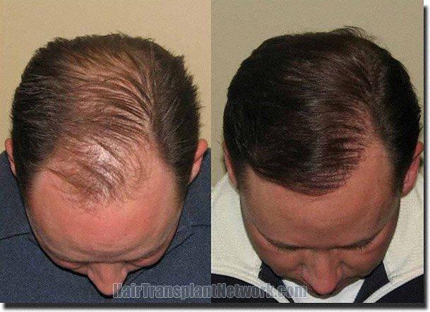 Hair restoration procedure results