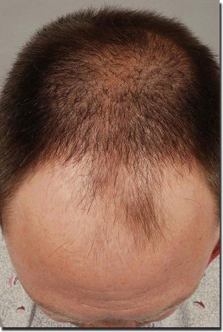 Hair restoration procedure results