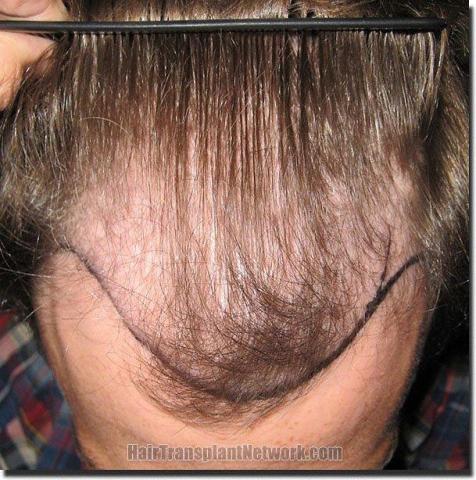 Hair restoration procedure results