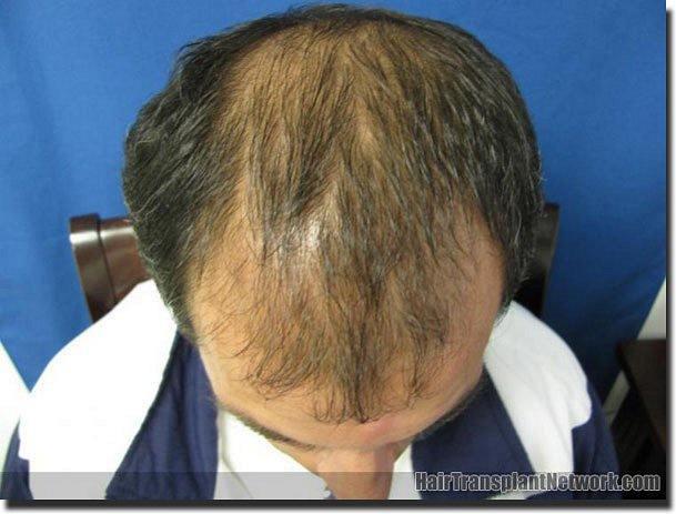 Hair restoration procedure results