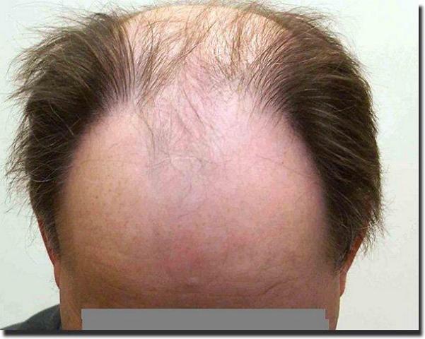 Hair restoration procedure results