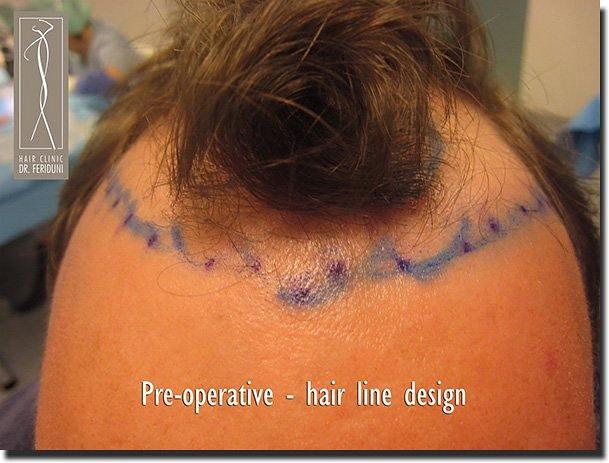 Hair restoration procedure results