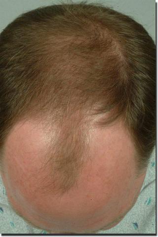 Hair restoration procedure results