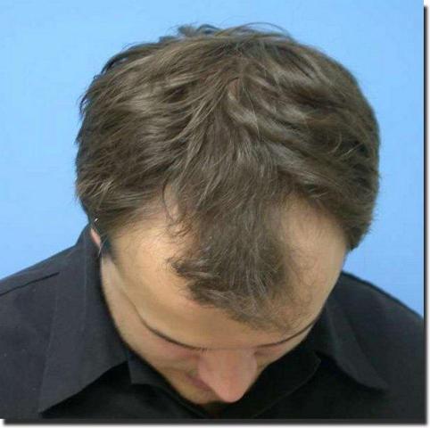 Hair restoration procedure results