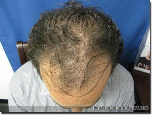 Hair restoration procedure results