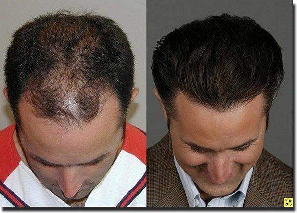 Hair restoration procedure results