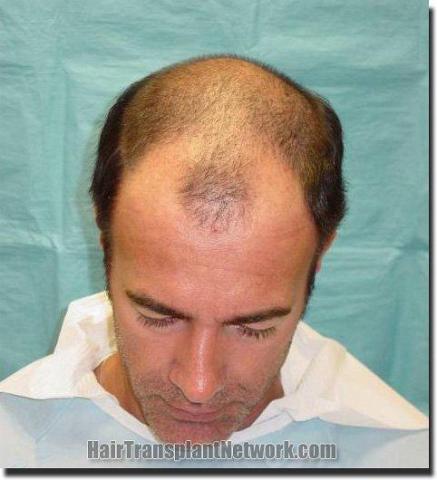 Hair restoration procedure results