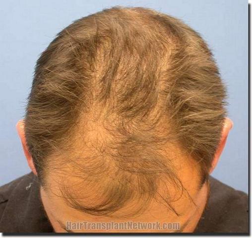 Hair restoration procedure results