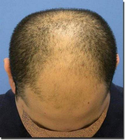 Hair restoration procedure results