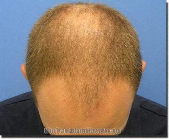 Hair restoration procedure results