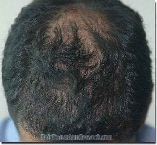 Hair restoration procedure results