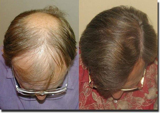 Hair restoration procedure results